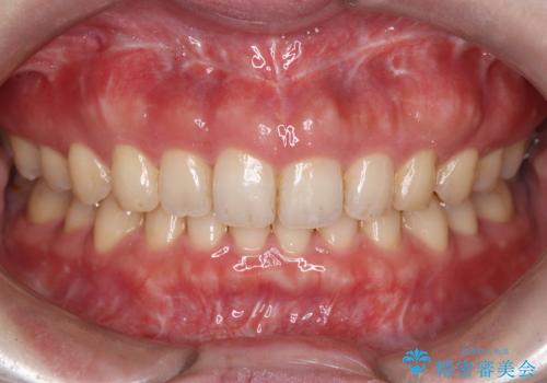 ホワイトニングで素敵ウエディングの治療前