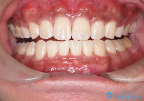 矯正後の初めてのホワイトニング