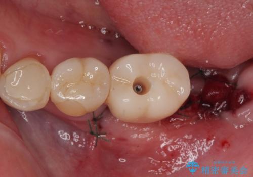 ブリッジから膿が出る 奥歯のインプラント治療の治療中