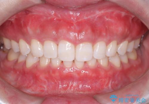 ホワイトニングで素敵ウエディング