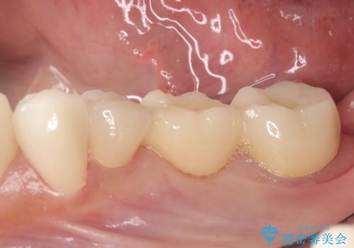 銀歯のブリッジをジルコニアブリッジへの治療後