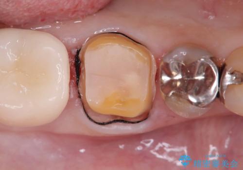 銀歯の下の虫歯|オールセラミッククラウンの治療中