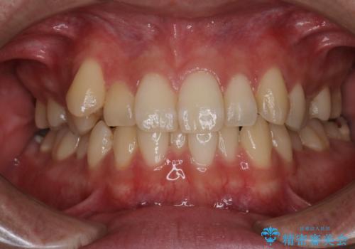 【クリア装置】八重歯とがたつきを綺麗に