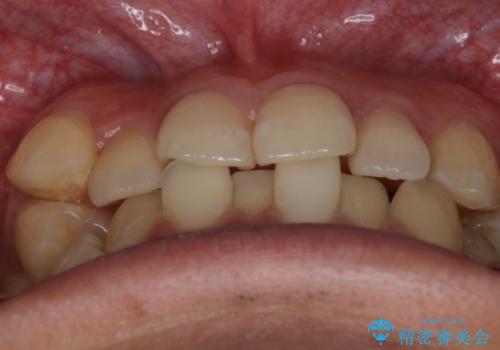 【クリア装置】八重歯とがたつきを綺麗にの治療前