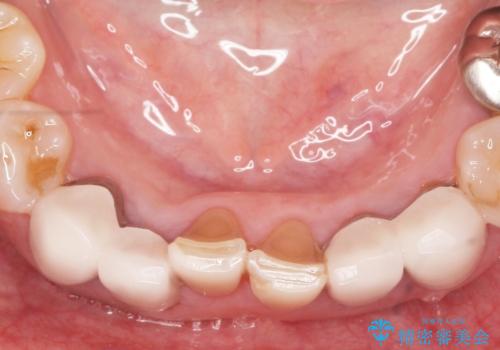 [ セラミック治療 ] 前歯の見た目を改善したいの治療前