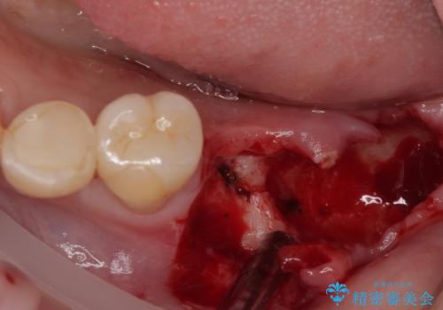 ブリッジから膿が出る 奥歯のインプラント治療の治療中