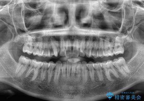 マウスピース矯正が煩わしい　ワイヤー装置での非抜歯矯正の治療前