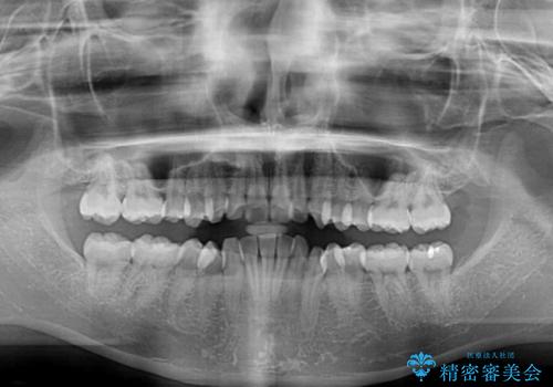 斜め前に飛び出した前歯 抜歯矯正で素敵な横顔にの治療前