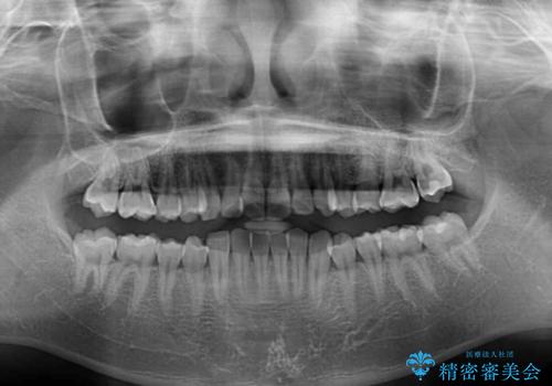 デコボコをインビザライン矯正で改善 奥歯は補助装置で確実に移動をの治療前