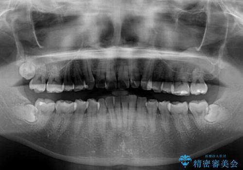 前歯のデコボコをインビザラインで綺麗に改善の治療前