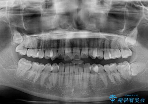 デコボコの非抜歯矯正 ワイヤー装置で楽して改善の治療前