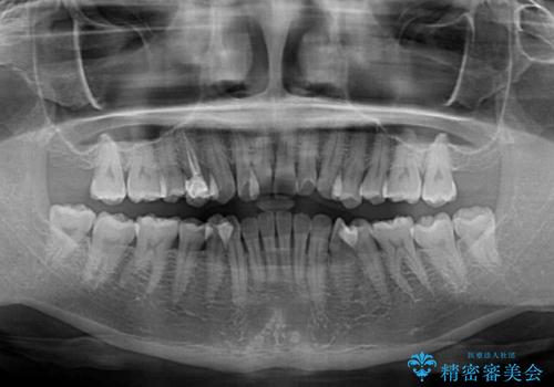 急速拡大装置 狭い歯列を拡大してクロスバイトを短期間矯正治療の治療前