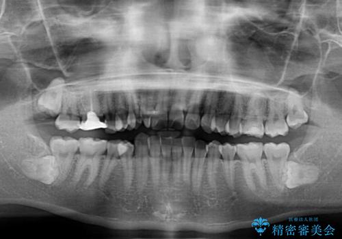 捻転の強い前歯 ワイヤー装置での非抜歯矯正の治療前