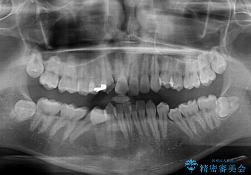 前歯のデコボコと正中のずれを改善!白い装置で目立たない矯正の治療前