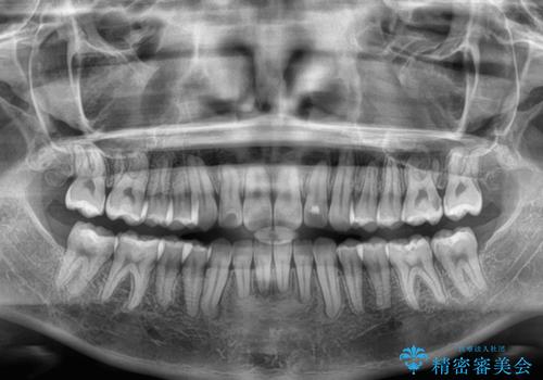 マウスピース矯正が煩わしい ワイヤー装置での非抜歯矯正の治療後