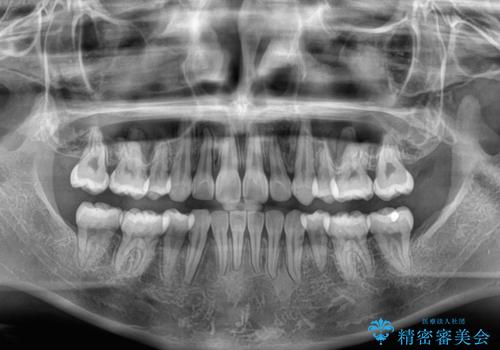 斜め前に飛び出した前歯 抜歯矯正で素敵な横顔にの治療後