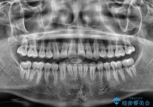 デコボコをインビザライン矯正で改善 奥歯は補助装置で確実に移動をの治療後