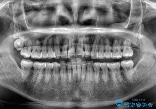 前歯のデコボコをインビザラインで綺麗に改善の治療後