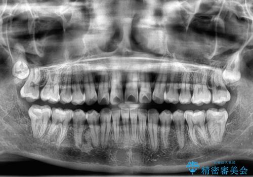 デコボコの非抜歯矯正 ワイヤー装置で楽して改善の治療後