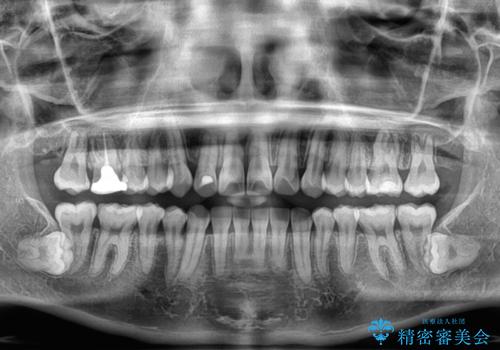 捻転の強い前歯 ワイヤー装置での非抜歯矯正の治療後
