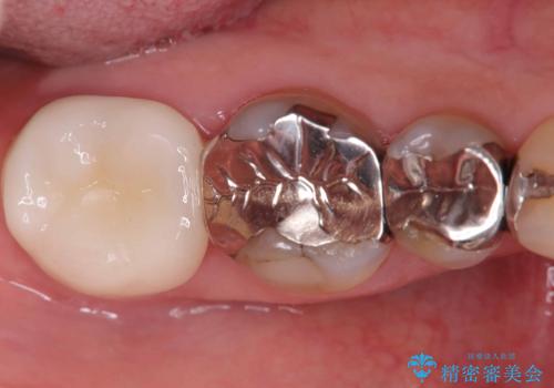 銀歯の下の虫歯|オールセラミッククラウンの症例 治療前