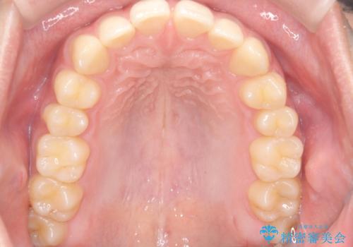 【ワイヤー矯正】すきっ歯を治したいの治療前