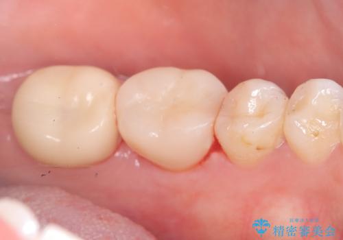 【歯牙移植】奥歯抜歯と言われたので親知らずを移植してほしいの治療後