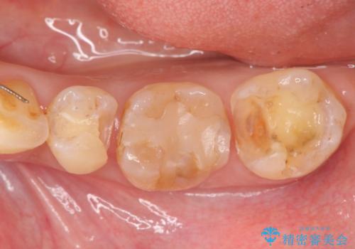 銀歯の下で虫歯の再発 拡大鏡下で行う虫歯の精密治療の治療中