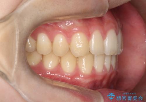 【ワイヤー矯正】すきっ歯を治したいの治療後