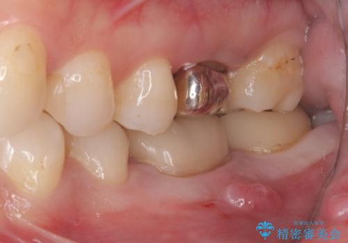 【歯牙移植】奥歯抜歯と言われたので親知らずを移植してほしいの治療前