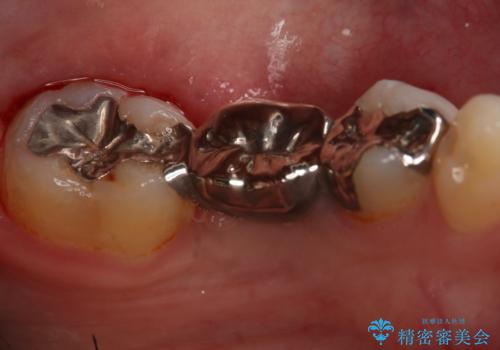 銀歯をやり変えたい フルジルコニアブリッジの治療前