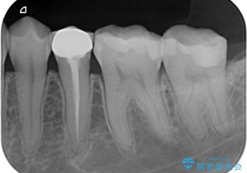 奥歯に虫歯があると言われた セラミッククラウンでキレイで長持ちする歯への治療前