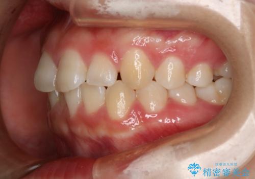 前歯のガタつきを治したい　インビザライン・ライトパッケージの治療前