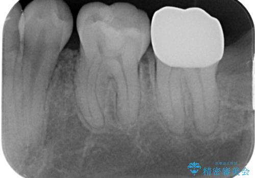 左下の奥歯が欠けた フルジルコニアクラウン・親知らず抜歯の治療後