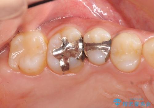 [ メタルフリー ] 銀歯を除去してのセラミック治療の症例 治療前