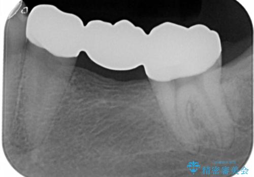 銀歯をやり変えたい フルジルコニアブリッジの治療後