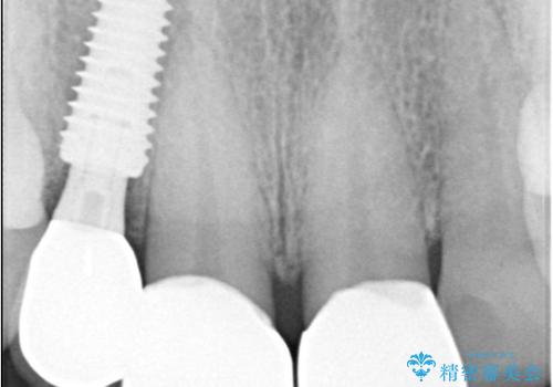 前歯の隙間とへこみが舌で触ると気になる|矯正治療は絶対にしたくない|抜歯即時インプラント+オールセラミッククラウンで審美修復の治療後