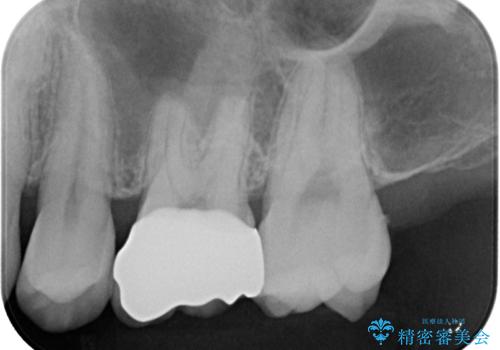 銀歯を外したい オールセラミッククラウンの治療後
