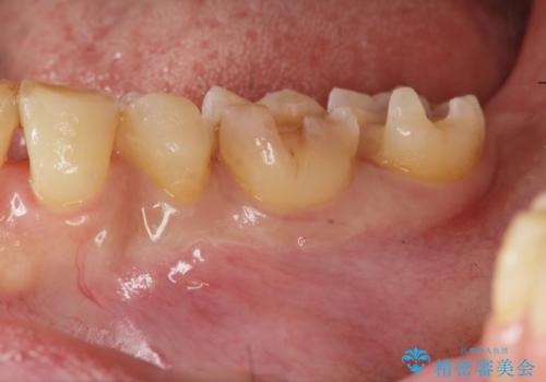 銀歯の下で虫歯の再発 拡大鏡下で行う虫歯の精密治療の治療中