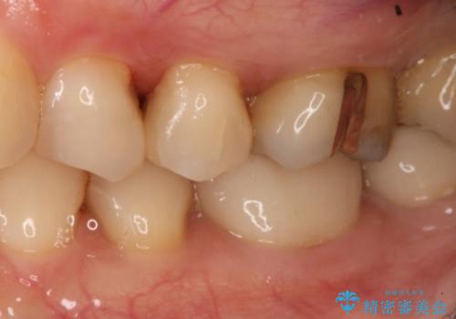 銀歯を白くしたい　セラミックインレーの治療後
