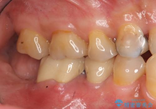 奥歯から膿のにおいがする インプラントによる機能回復の治療前