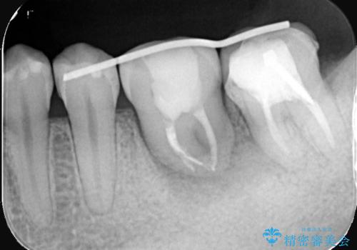 【歯牙移植】奥歯抜歯と言われたので親知らずを移植してほしいの治療中