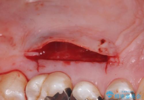 歯肉退縮に対する結合組織移植の治療中