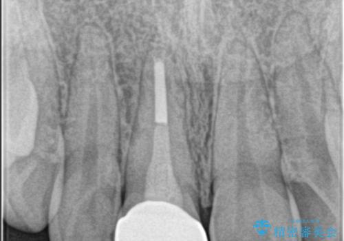 前歯が欠けた。の治療後