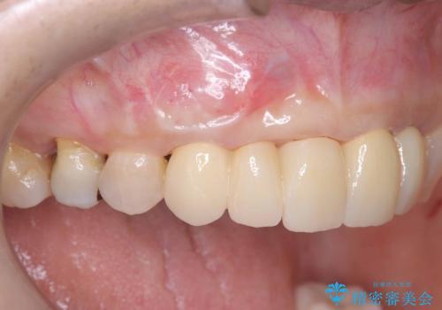 歯茎の腫れが気になる方必見!|抜歯即時インプラントで前歯5本を痛みなく3か月で治療完了!の治療後