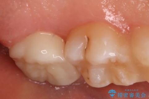 奥歯を治療したい フルジルコニアクラウンの治療後