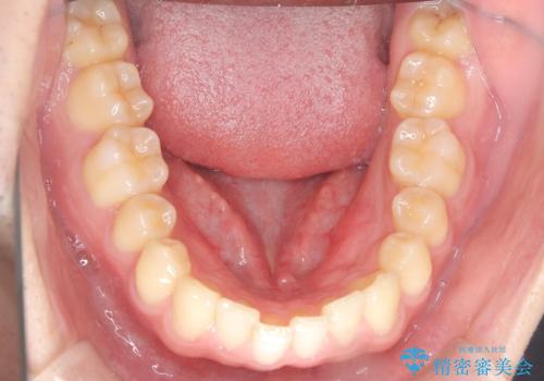 【ワイヤー矯正】すきっ歯を治したいの治療前