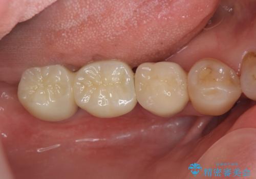 奥歯から膿のにおいがする インプラントによる機能回復の治療後