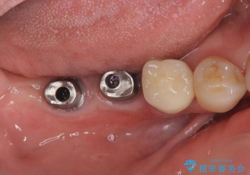 奥歯から膿のにおいがする インプラントによる機能回復の治療中