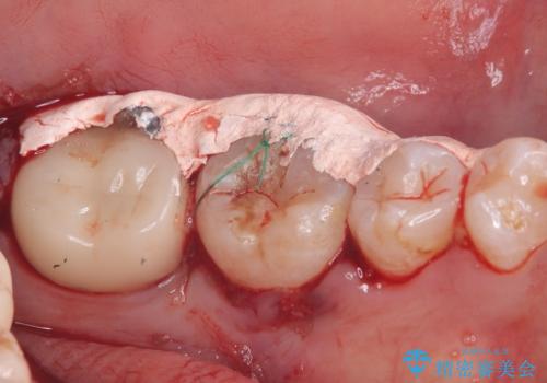 【歯牙移植】奥歯抜歯と言われたので親知らずを移植してほしいの治療中